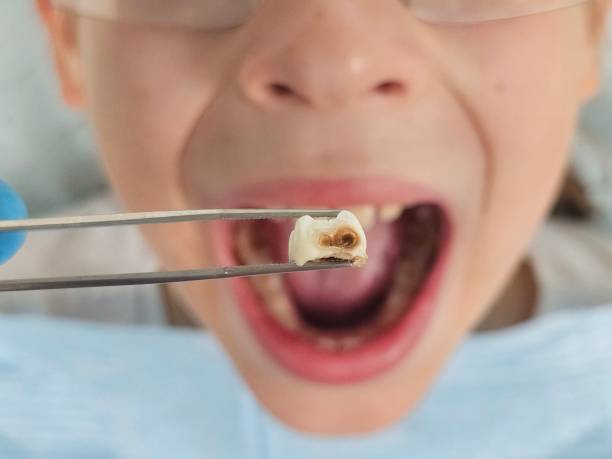 Best Emergency Dentist for Knocked-Out Tooth in North Redington Beach, FL